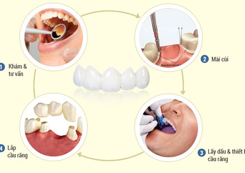 Làm răng sứ mất bao lâu? Cách nào rút ngắn thời gian? 2