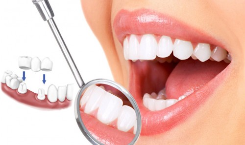 Làm răng sứ thẩm mỹ loại nào tốt? Tư vấn nha khoa 1