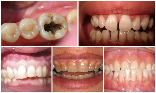 Làm răng sứ thẩm mỹ loại nào tốt? Tư vấn nha khoa 2