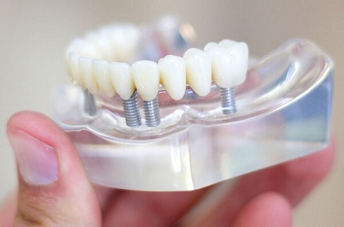 Răng sứ titan có mấy loại? Nên chọn loại nào?