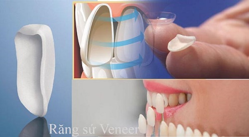 Làm răng sứ veneer - Các trường hợp nên áp dụng 3