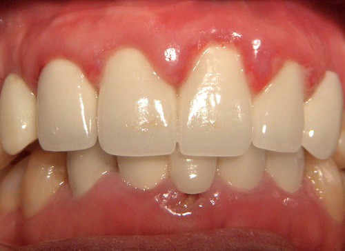 Lắp răng sứ bị sưng lợi - Nguyên nhân bạn nhất định phải biết 1