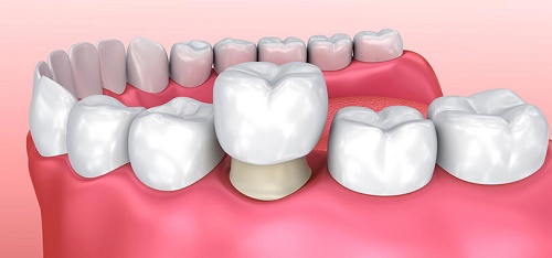 Lắp răng sứ bị sưng lợi - Nguyên nhân bạn nhất định phải biết 2