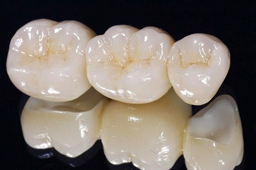 Răng sứ ceramill là gì? Ưu điểm của răng sứ ceramill
