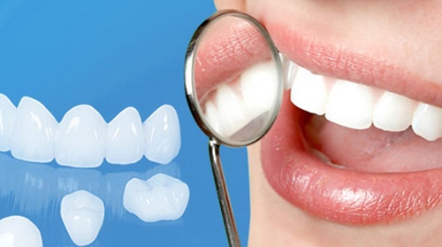 Bọc răng sứ có niềng được không? Một số lưu ý cho bạn 1