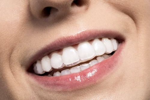 Bọc răng sứ có niềng được không? Một số lưu ý cho bạn 2