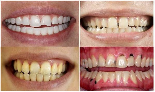 Răng sứ veneer có tốt không? Áp dụng cho các trường hợp nào? 1