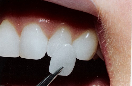 Răng sứ veneer có tốt không? Áp dụng cho các trường hợp nào? 2