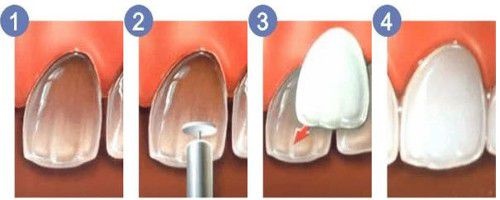 Răng sứ veneer là gì? Loại răng này có ưu điểm gì? 1