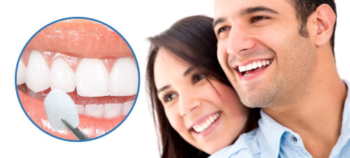 Răng sứ veneer là gì? Loại răng này có ưu điểm gì? 3