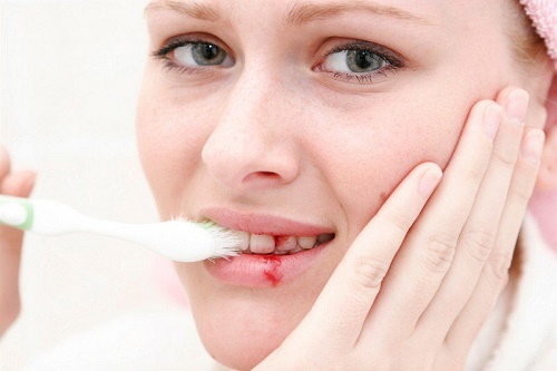 Chảy máu chân răng khi đánh răng có bình thường không? 1