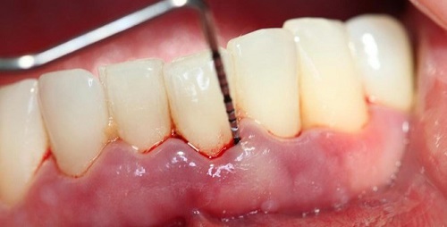 Chảy máu chân răng khi đánh răng có bình thường không? 2