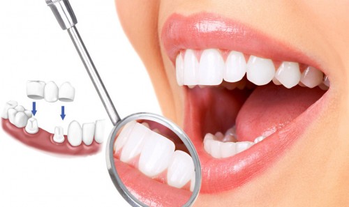 Làm răng sứ phải kiêng gì? Chế độ chăm sóc phù hợp 1 Làm răng sứ phải kiêng gì? Chế độ chăm sóc phù hợp 1