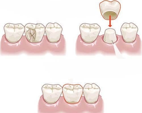 Răng sứ bị mòn - Các giải pháp khắc phục tối ưu cho bạn 2