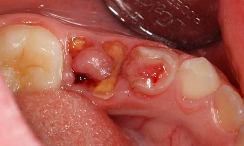 Răng sứ bị nhức sau phục hình bởi do 2 nguyên nhân này