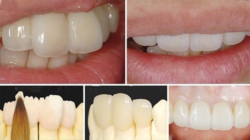 Răng sứ bị nứt phải làm sao để khắc phục? Tư vấn nhanh 1