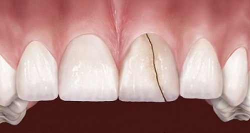 Răng sứ bị nứt phải làm sao để khắc phục? Tư vấn nhanh 2