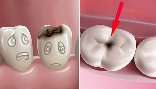 Răng sứ bị sâu có đúng không? Chăm sóc răng sứ thế nào là tốt? 2