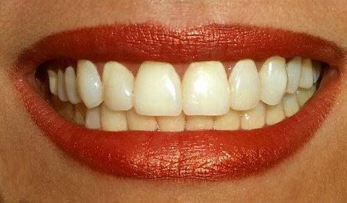 Cách khắc phục răng sứ bị vàng hiệu quả cho bạn 1
