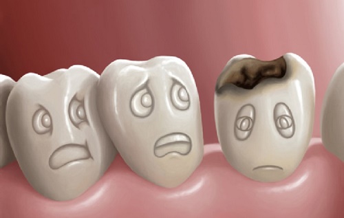 Răng sứ có bị sâu không? Cần lưu ý gì trong việc chăm sóc? 1