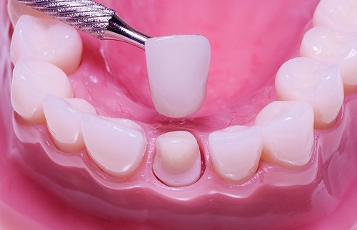 Răng sứ có bị sâu không? Cần lưu ý gì trong việc chăm sóc? 2