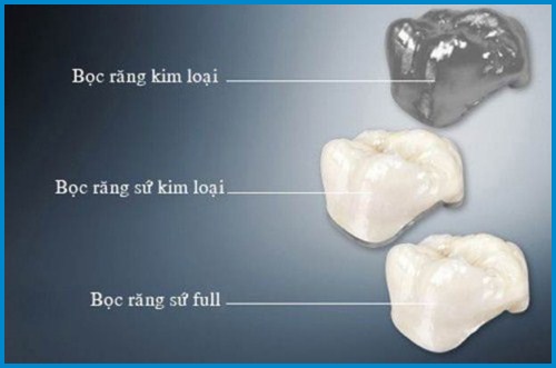 Răng sứ có bị xuống màu không? Chế độ chăm sóc khoa học 2 Răng sứ có bị xuống màu không? Chế độ chăm sóc khoa học 2