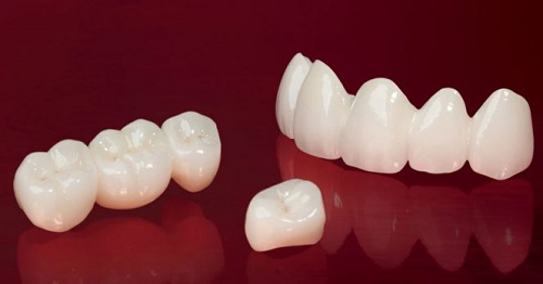 Răng sứ có tháo ra được không nếu muốn làm răng mới? 3