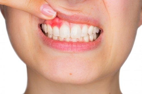 3 cách điều trị viêm chân răng có mủ cho bạn 1