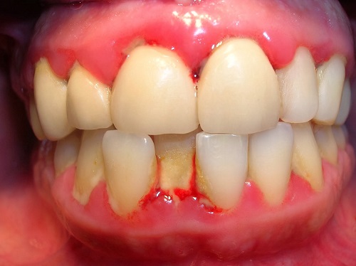 3 cách điều trị viêm chân răng có mủ cho bạn 3