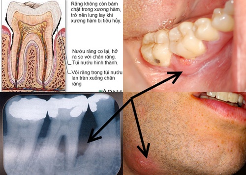 4 dấu hiệu viêm chân răng cho bạn được biết 2