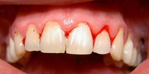 4 dấu hiệu viêm chân răng cho bạn được biết 3