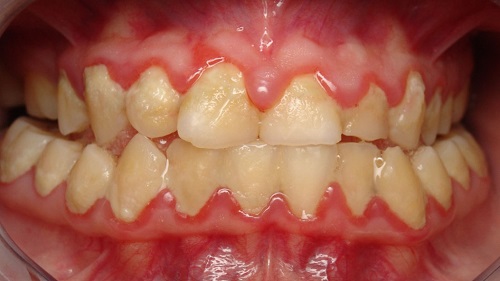 Viêm chân răng có nguy hiểm không? Ảnh hưởng viêm chân răng gây ra 1