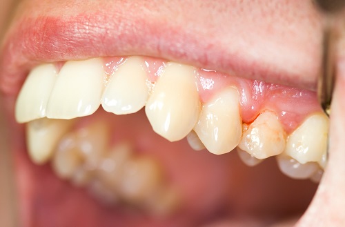 Viêm chân răng có nguy hiểm không? Ảnh hưởng viêm chân răng gây ra 2
