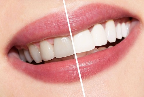 Tẩy trắng răng bằng than củi có được không? 4