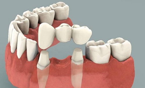 Trồng răng sứ cố định có tốt không? Tìm hiểu ưu điểm