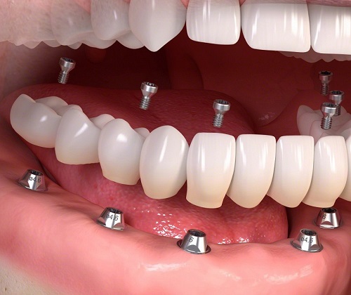 Trồng răng sứ cố định có tốt không? Tìm hiểu ưu điểm