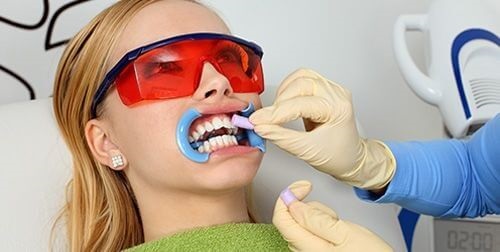 Tẩy trắng răng bằng máng có tốt không? Tìm hiểu ngay 3