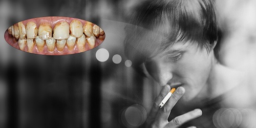 Tẩy trắng răng hút thuốc có sao không? Tư vấn cụ thể 2