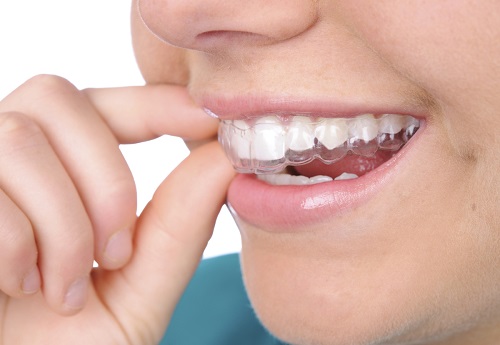 Tẩy trắng răng bằng máng bao nhiêu tiền? Tham khảo 2