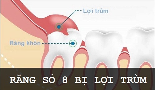 Cắt lợi trùm răng khôn có đau không? Cần lưu ý gì khi thực hiện? 2