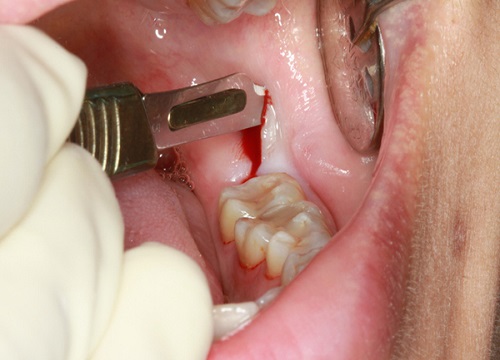 Cắt lợi trùm răng khôn có đau không? Cần lưu ý gì khi thực hiện? 3