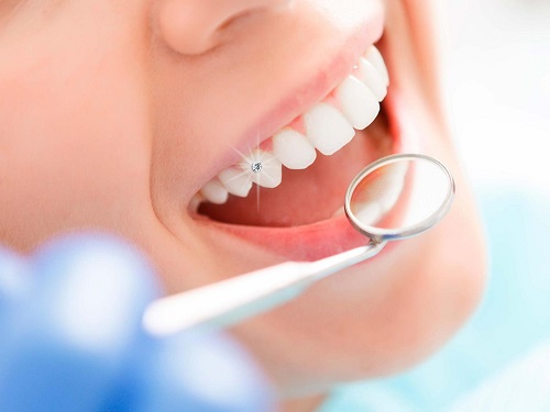 Đính đá vào răng có hại không? Bác sĩ tư vấn *