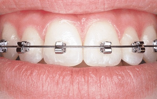 Kết luận: Ê buốt khi niềng răng có sao không? *