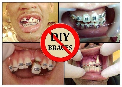 Niềng răng bị hỏng - Cách khắc phục xử lý 2 Niềng răng bị hỏng - Cách khắc phục xử lý 2