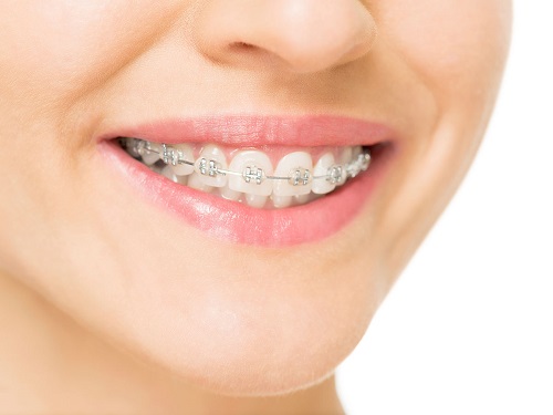 Niềng răng bị lòi chân răng - Nguyên nhân do đâu? *