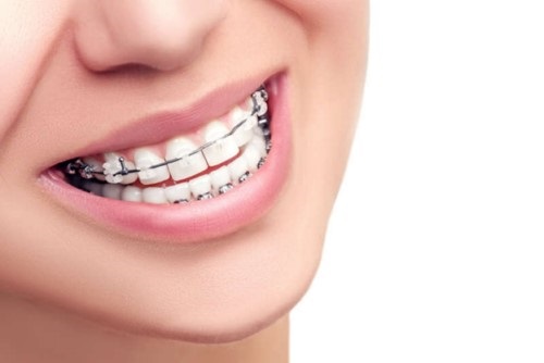 Niềng răng gây hôi miệng - Mẹo xử lý hiệu quả 1