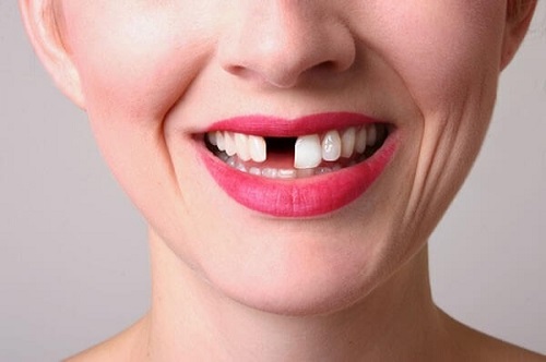 Trồng răng có ảnh hưởng gì không? Tham khảo nhanh 1