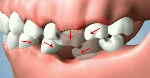 Trồng răng có ảnh hưởng gì không? Tham khảo nhanh 3