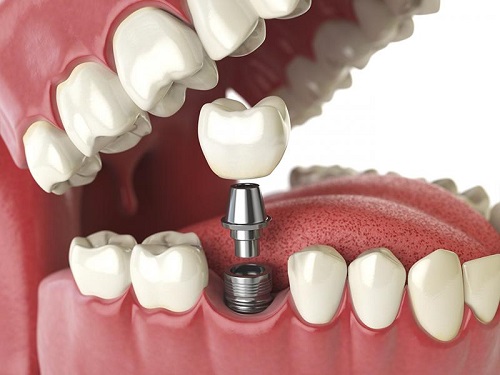 Trồng răng có ảnh hưởng gì không? Tham khảo nhanh 4