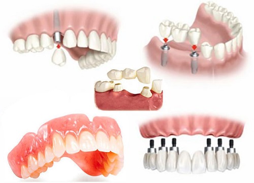 Trồng răng cửa hàm dưới với phương pháp nào? 1